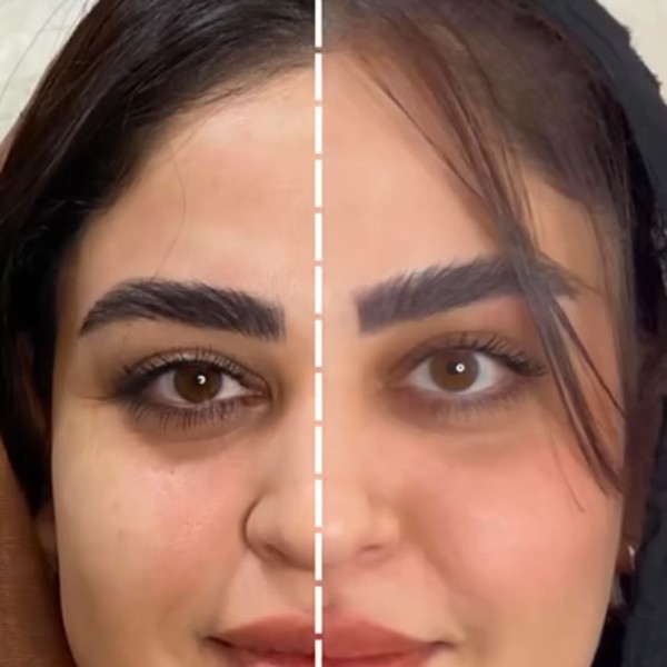 بوتاکس ابرو
