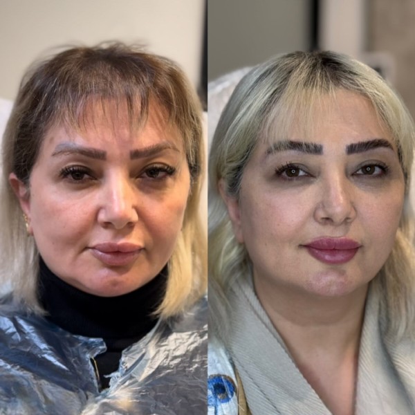 لیفت با نخ