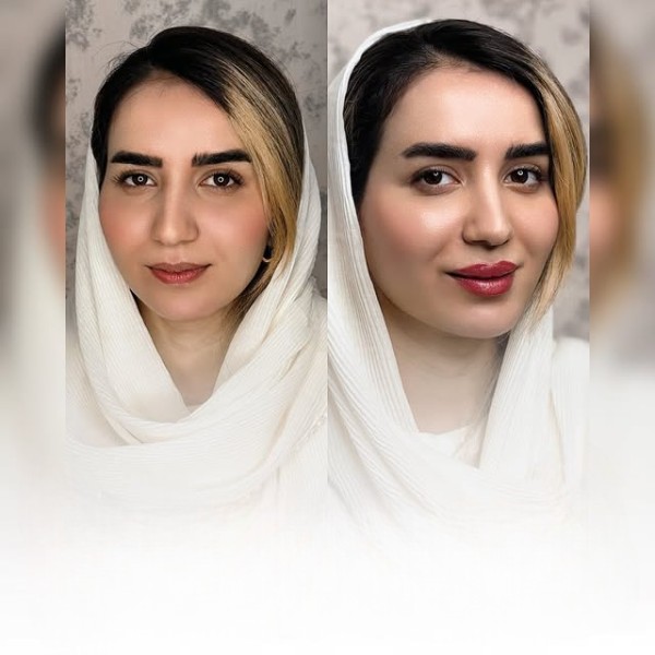 فیلر لب