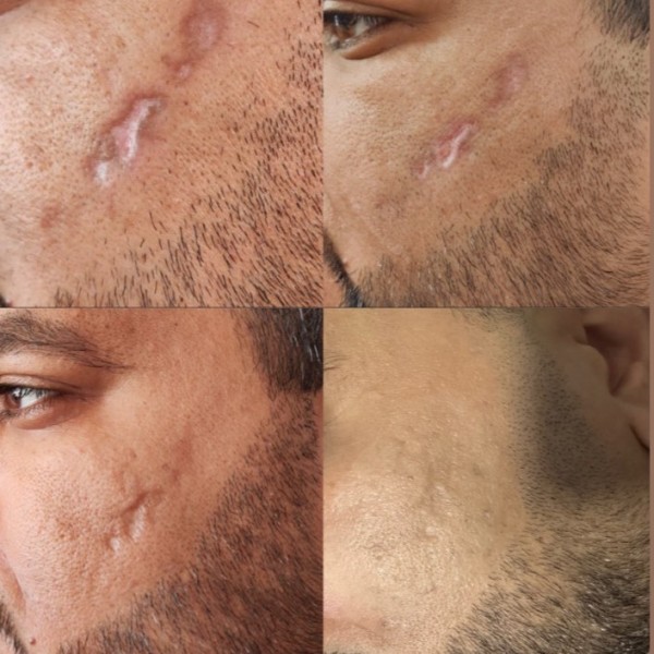 درمان اسکار
