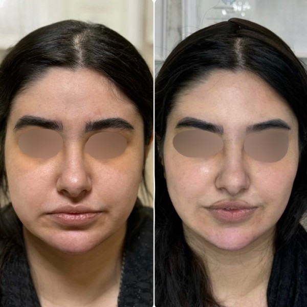 تزریق فول فیس