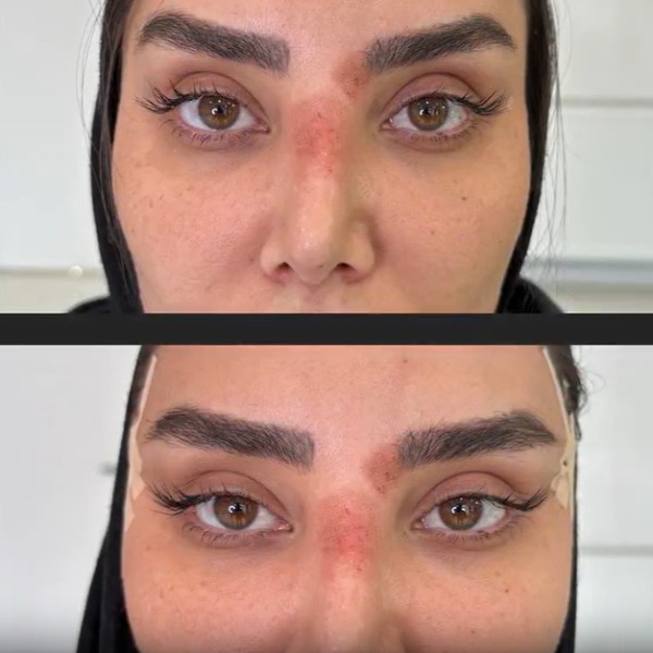 بوتاکس چشم گربه ای