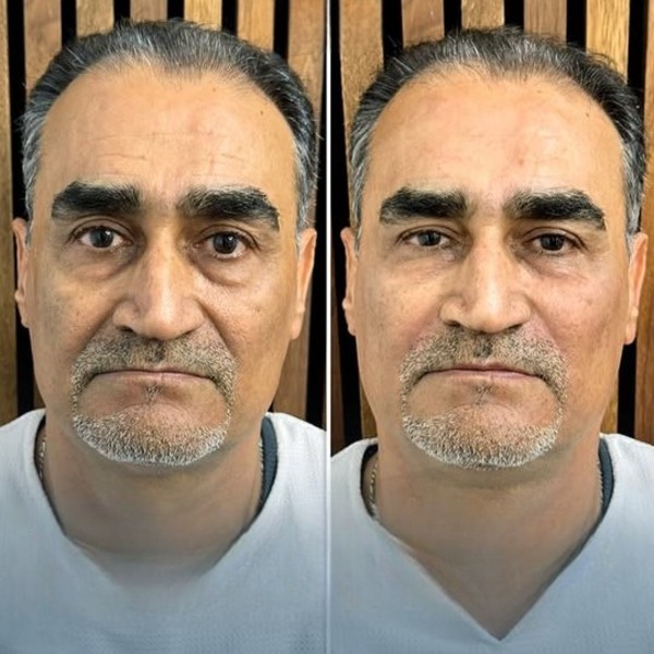 فیلر خط خنده
