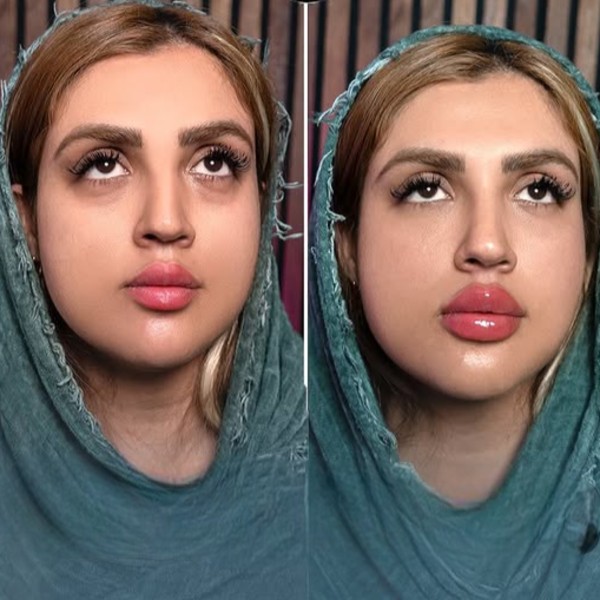 فیلر لب