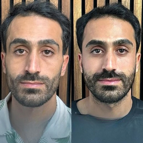 تزریق میدفیس