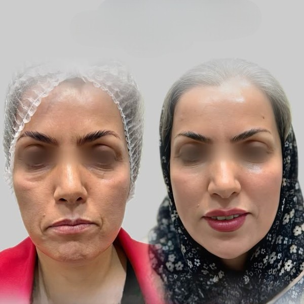 تزریق فول فیس