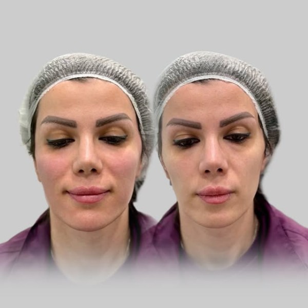 تزریق فول فیس