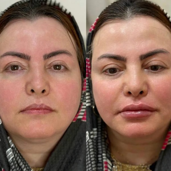 فیلر فول فیس