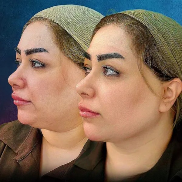 ساکشن غبغب