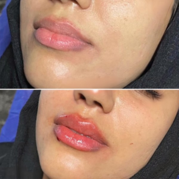 فیلر لب