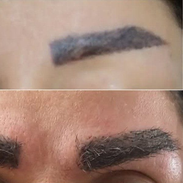مزوتراپی ابرو