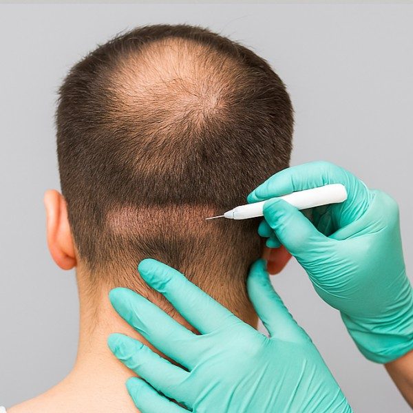 کاشت مو به روش fit چیست؛ مراحل، مراقبت ها و هزینه